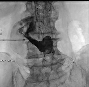 89 yo w/type 2 endoleak and growing aneurysm sac. Translumbar access followed by embolization with Onyx 34. #IRad #Onyx #endoleak @SIRRFS @SIRspecialists @GESTSymposium @SunilNarayanMD @ncdoro