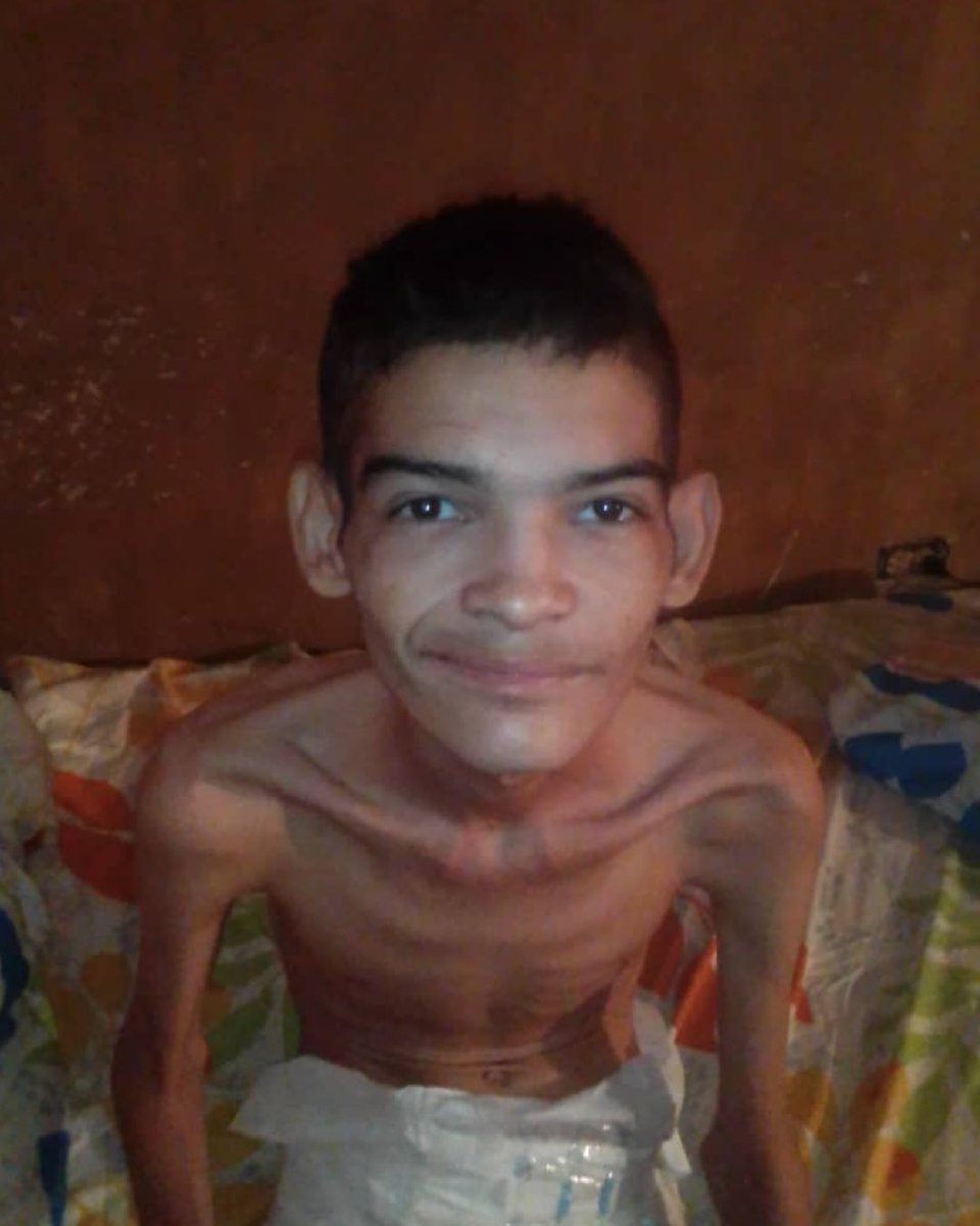 ManuelConecta's tweet photo. Hace poco, conocí a Pedro. En un estado de desnutrición severo pesando 26 (kg) con 20 años, y con una situación con respecto a su diábetes, sumamente complicada. Hoy, luego del apoyo de muchas personas y de la intervención de Dios, días después, pesa 32 y está aumentando. https://t.co/UcqA66gcIj