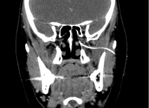 NarouzeMD's tweet photo. 🆕@AnnalsHeadache Continuous Sphenopalatine Ganglion #SPG catheter for Refractory Hemicrania Continua.
Innovative approach by Restrepo-Garces, Saldarriaga, @Sebopi 🙌🏼

Awesome figures!
@aihsHeadache @HeadacheBoard 
https://t.co/qoAu9V9rY3 https://t.co/CZ06nNH2Cr