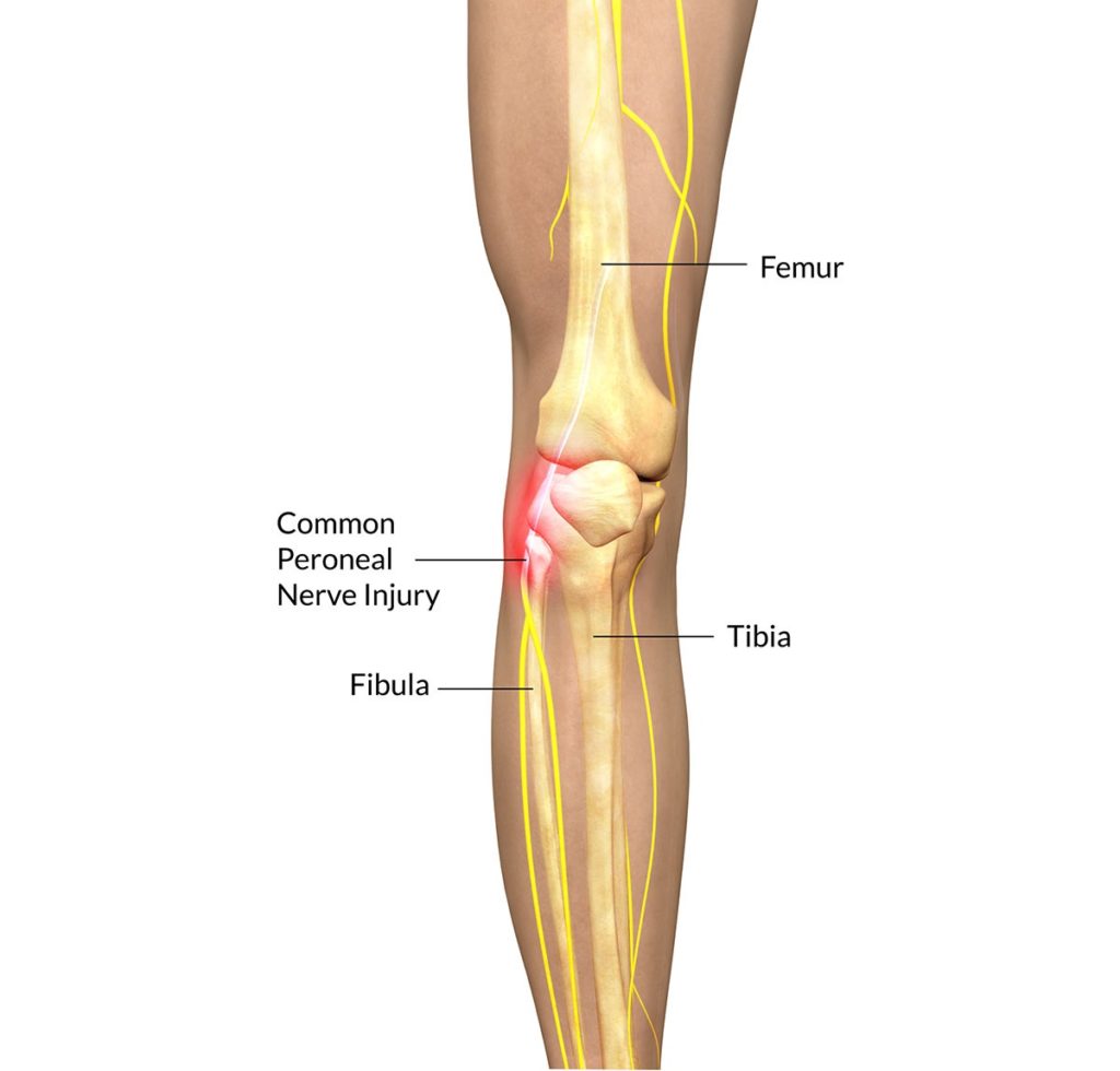 What does the outside CALF kick do? This strike doesn't actually strike the calf, but instead the PERONEALS that run on the outside of the Fibular. You have a very crucial nerve supple right at this area.