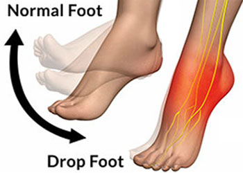 This compartment where this nerve passes through is SUPER SMALL. Therefore, even slight swelling in the area will begin to COMPRESS the nerve. Without this nerve supply, the foot becomes 'dead' and drops.