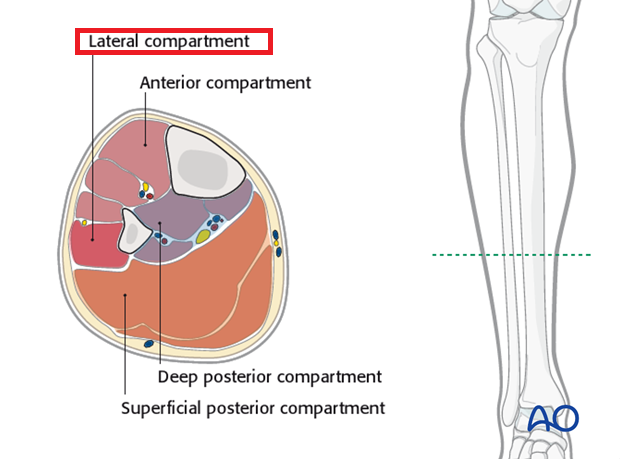 This compartment where this nerve passes through is SUPER SMALL. Therefore, even slight swelling in the area will begin to COMPRESS the nerve. Without this nerve supply, the foot becomes 'dead' and drops.