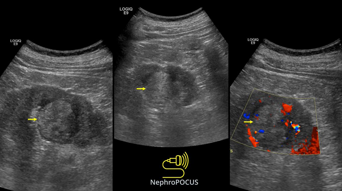 #Nephrology #POCUS pearl of the day:
We generally say renal masses disrupt the outline of the kidney. But not 💯 👇
In addition to kidney outline, pay attention to 'continuity' of the parenchyma, take a closer look when its not.
"See Something Say Something" #MedEd