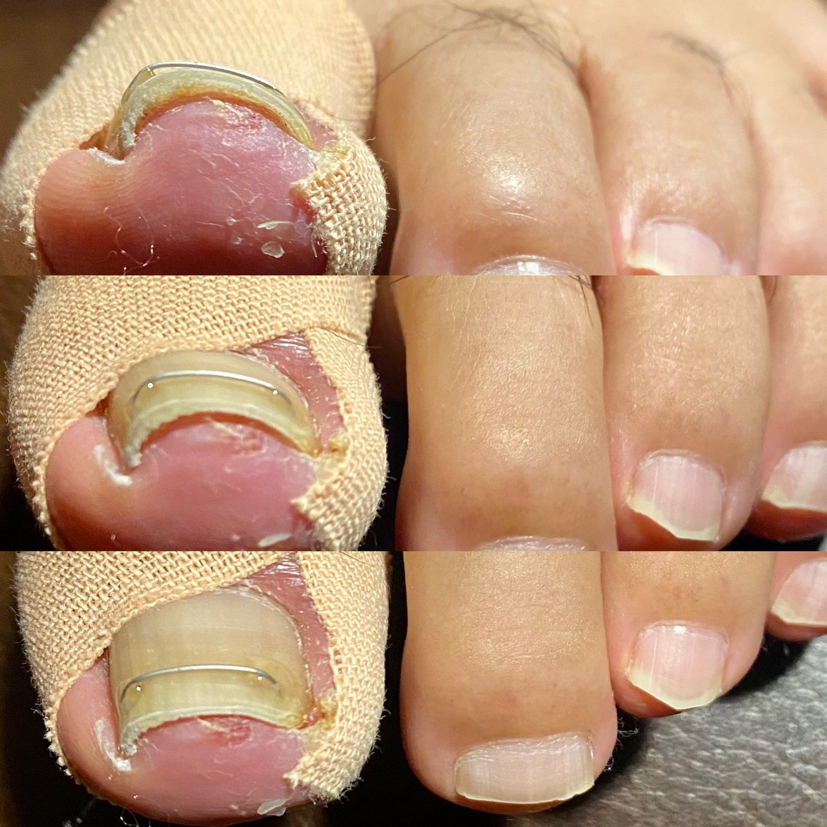 フットマッサージbarefoot 痛みがある状態でも テーピングをして痛みの原因の爪のトゲを取り除くだけでかなり楽になり あとはワイヤーをかけると爪が浮いて更に楽になります 月に一度掛け替え 半年から一年で真っ直ぐ綺麗な爪に 一カ所3 000円 お気軽にご フットマッサージbarefoot 痛みがある状態でも テーピングをして痛みの原因の爪のトゲを取り除くだけでかなり楽になり あとはワイヤーをかけると爪が浮いて更に楽になります 月に一度掛け替え 半年から一年で真っ直ぐ綺麗な爪に 一カ所3 000円 お気軽にご