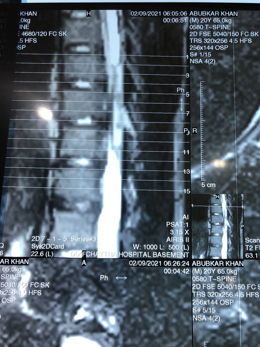 NeuroDr69's tweet photo. 20yrs old Young boy, who suddenly developed Paraplegia 3 days back. His MRI shows D8-10 Epidural Abscess. 
Just operated, whole pus drained &amp; Dura decompressed successfully. InshaAllah He will recover soon 🌹
#EpiduralAbscess #Neurosurgery #SpinalSurgery #Paraplegia https://t.co/RUvipCqYSE