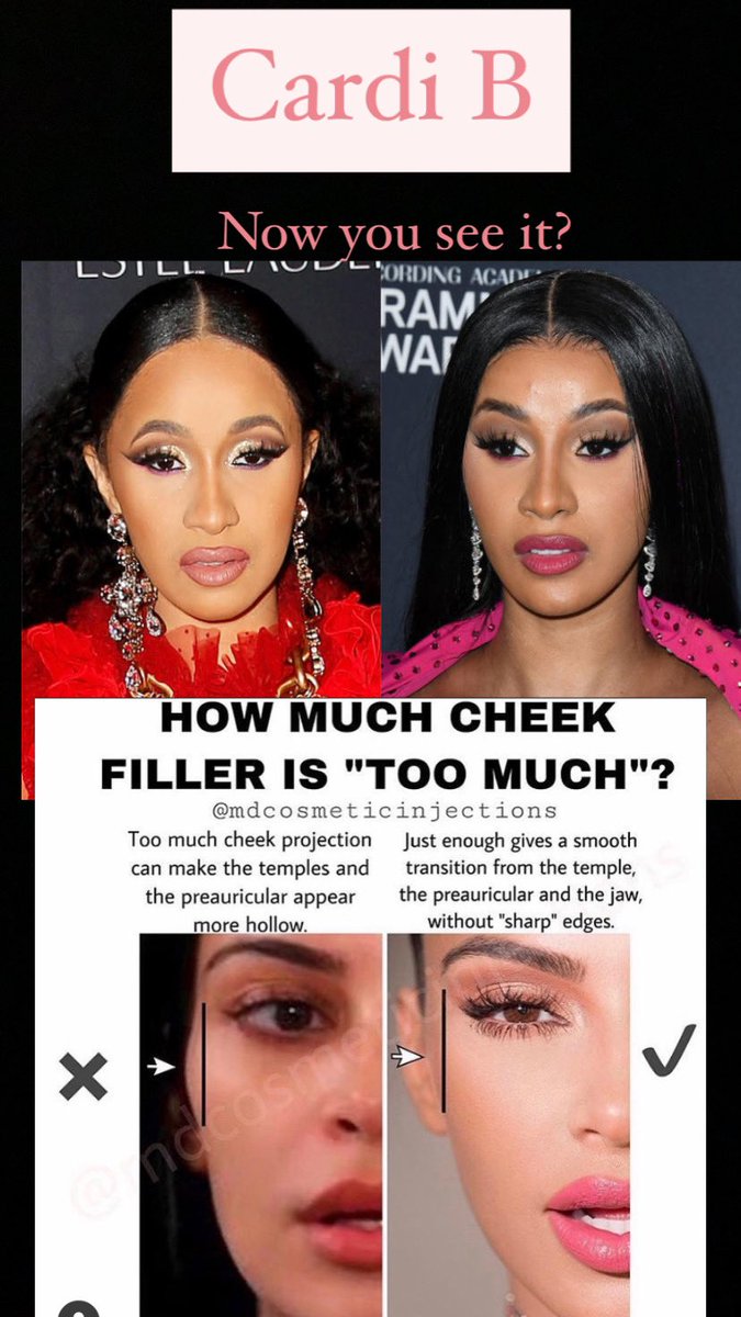 This is nothing more than too much filler ( or possibly fat) injected in her face. This can be fixed, but the longer she waits the more damage she will cause......However she seems very happy with her look.