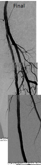 tan_guangming's tweet photo. @EricSecemskyMD @CUHKMedicine #Astato wired back then #Supera to bridge the two stents (not taking chances with open cells stents anymore). all done with Biplane. https://t.co/C3s95LgC1L