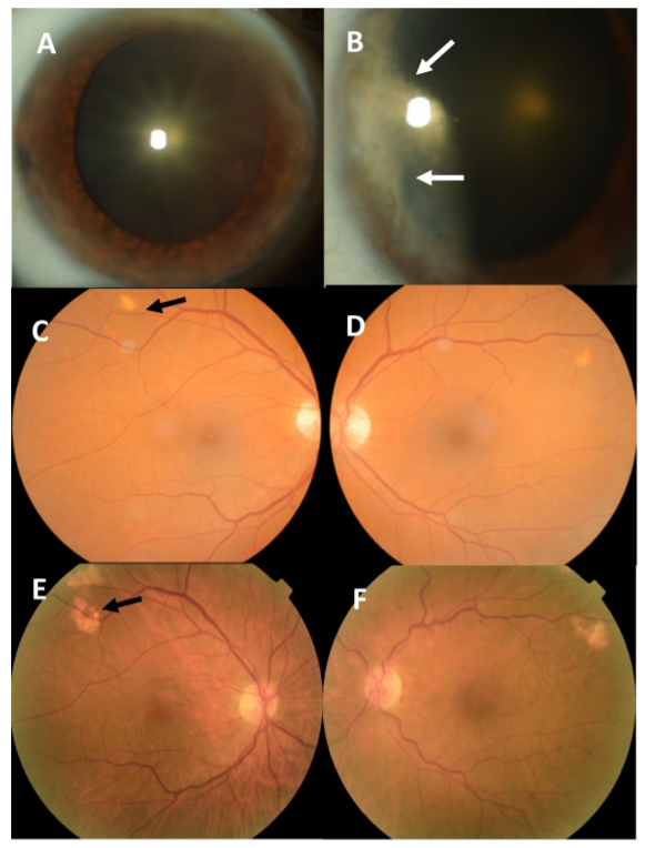 CKJsocial's tweet image. 🆕Review:
Gitelman syndrome and ectopic calcification in the retina and joints 
➡️bit.ly/2Z5r2uV🔓
#BartterSyndrome #chondrocalcinosis #GitelmanSyndrome #hypertension #retina #joints