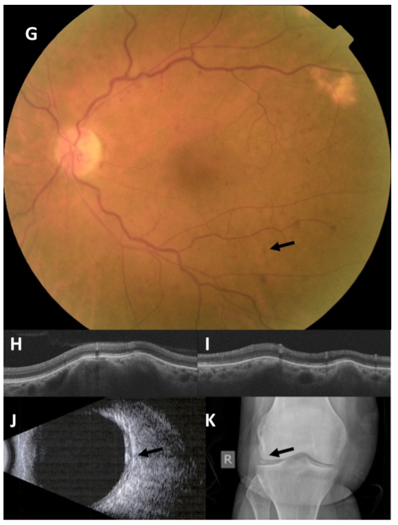 CKJsocial's tweet image. 🆕Review:
Gitelman syndrome and ectopic calcification in the retina and joints 
➡️bit.ly/2Z5r2uV🔓
#BartterSyndrome #chondrocalcinosis #GitelmanSyndrome #hypertension #retina #joints