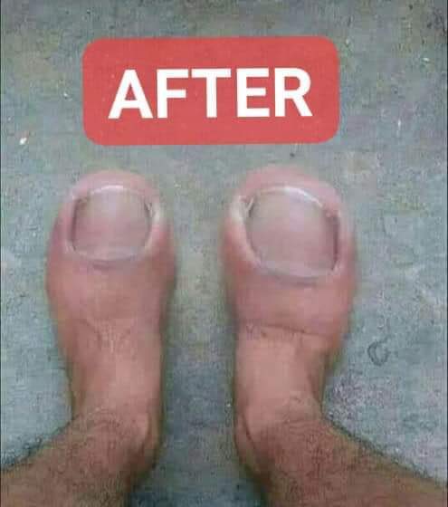 NodeGroupOnline's tweet image. Foot braces😂🤣😂