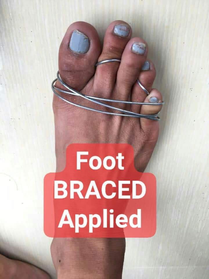 NodeGroupOnline's tweet image. Foot braces😂🤣😂