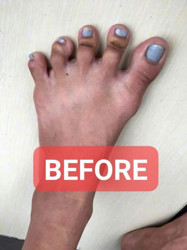 NodeGroupOnline's tweet image. Foot braces😂🤣😂