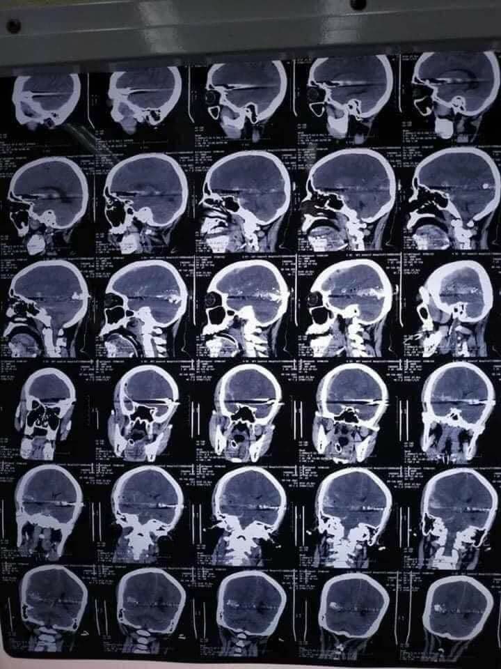 'The journey of a bullet'
CT scan of Myat Thet Thet Khine's skull
Glasgow coma score = 3 ( brain dead )

#Myanmar #Burma #WhatishappeninginMyanmar #FightForDemocracy #Coup9Feb #Reject_the_military