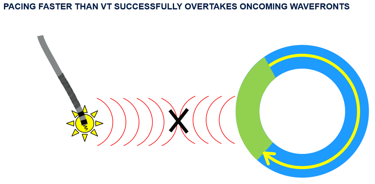 narrowQRS's tweet photo. 🚨🚨🚨New video alert!
Presentation on how anti-tachycardia pacing (ATP) works to terminate VT. Mechanisms of reentry, varied interactions between pacing and VT are reviewed. A new ATP algorithm is reviewed, but lots of basic principles discussed here!

https://t.co/MDZ2SGdGJp https://t.co/KYzpTQ5ARt