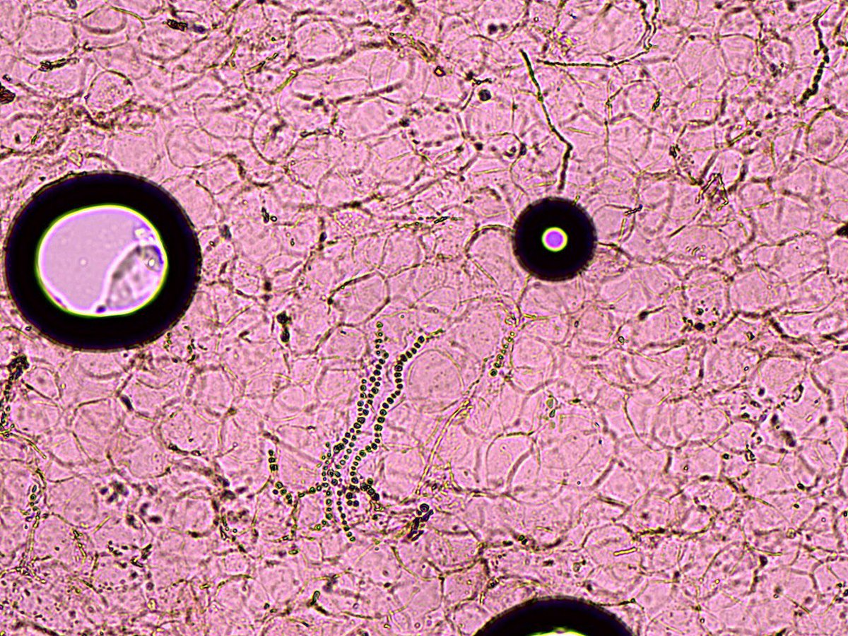 Onicomicosis . Detalle : micelio desarticulado en artrosporas