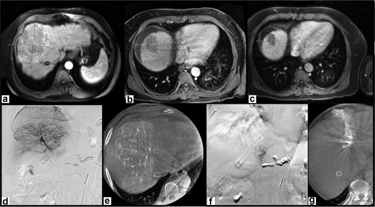Safety and Efficacy of Segmental Yttrium-90 Radioembolization for Hepatocellular Carcinoma after Transjugular Intrahepatic Portosystemic Shunt Creation | ow.ly/Vdio50DnlCU #irad