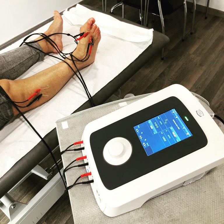 Neuromodulación de peroneos + interoseos con Endomed484 de <a href="/EnrafNonius/">Enraf-Nonius Nederland</a> 

¡Tto 🔝 para metatarsalgias!

#centrosanttelm #fisioterapia #fisioterapiainvasiva #fisioterapiaintervencionista #neuromodulacion #endomed484 #primfisio #ecografia #sonography #metatarsalgia #metatarsos