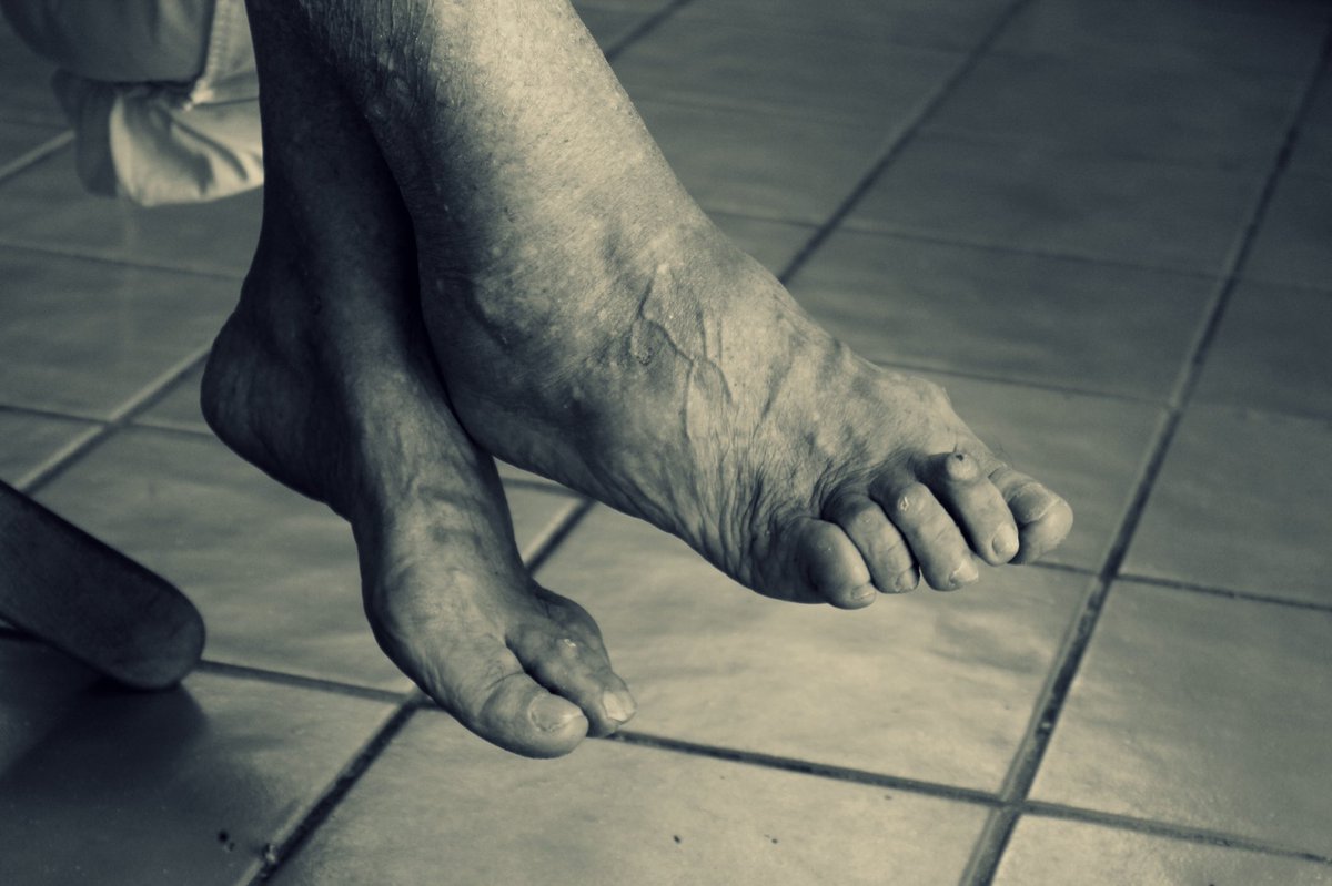 FeelYourFeet's tweet photo. A new report indicates that more people are struggling to look after their feet during COVID-19. 
What’s your experience been during the pandemic? Have your feet suffered?
 #WednesdayThoughts #WednesdayWisdom #MediPedi #Pedicure #Callus #Corn #DrySkin #CrackedHeels #ToeNails https://t.co/UoNqf7E2Gs