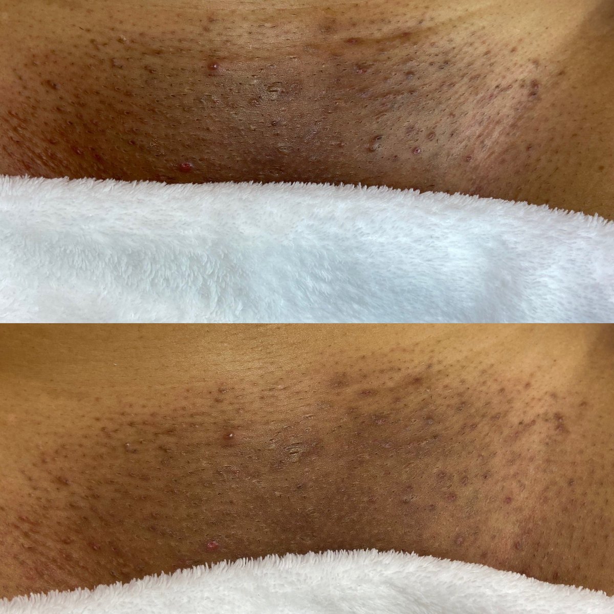 Brazilian Lightening Treatment <a href="/labelspanc/">La Bel Spa</a> #RaleighNC #BrazilianWax