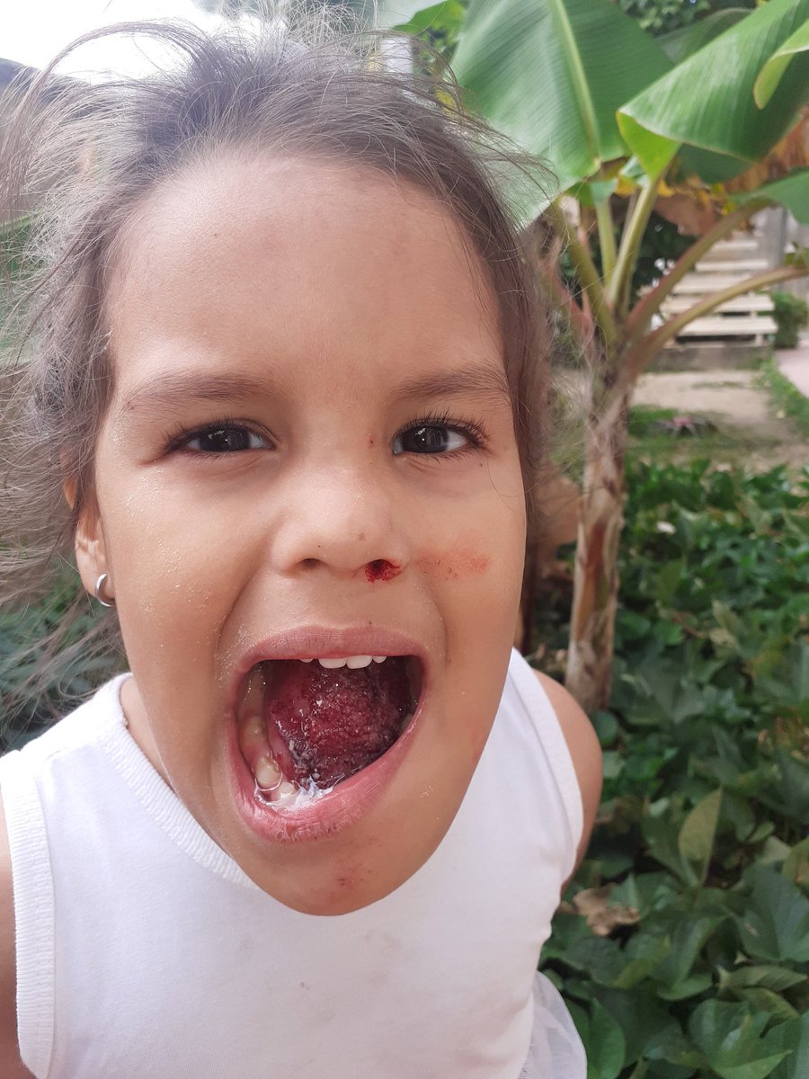 Gerajose1's tweet photo. Mi hija necesita la ayuda necesaria para ser operada por tercera vez a su corta edad por favor mi pequeña solo quiere seguir sonriendo como siempre nos encontramos en la ciudad de caracas de maturin por favor ayuda 04168852396 @dcabellor @NicolasMaduro @ConCiliaFlores https://t.co/brPvvlgT1z