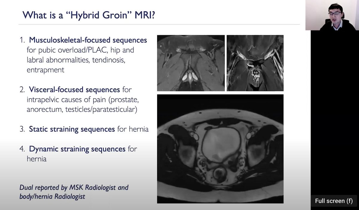 2/7 our expert rads: Groin pain is complex: you can't just get MR scan pelvis. Hybrid MRI gold standard but US better at Dx hernia. Solution: MRI with dynamic imaging + double reporting from MSK/body MRI. US might be better for small hernias but may over call. And I love the 3D.