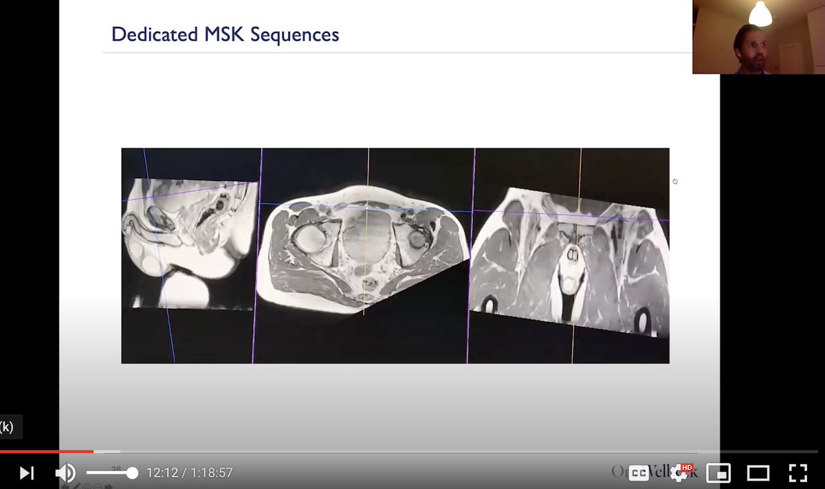2/7 our expert rads: Groin pain is complex: you can't just get MR scan pelvis. Hybrid MRI gold standard but US better at Dx hernia. Solution: MRI with dynamic imaging + double reporting from MSK/body MRI. US might be better for small hernias but may over call. And I love the 3D.