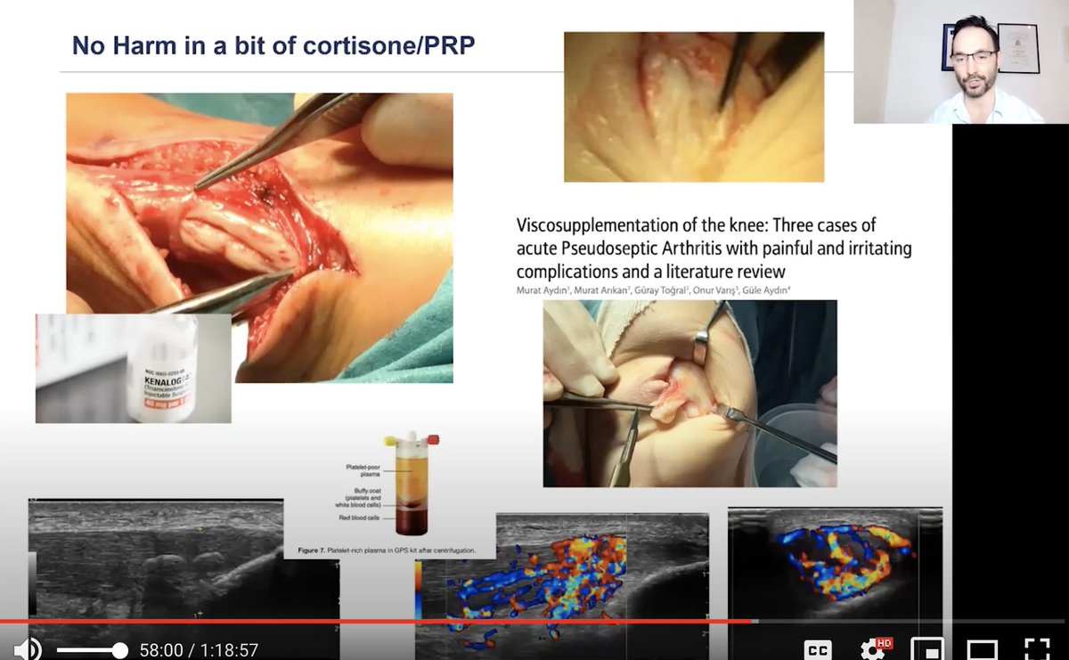 6/7I discussed injections for pubic overload - generally v low utility. Exercise therapy is the way forward. PRP does not cure everything and cortisone inj can cause serious harm. Nerve blocks may be useful for 1) Diagnostic utility 2) dampen pain response but less harm than PRP