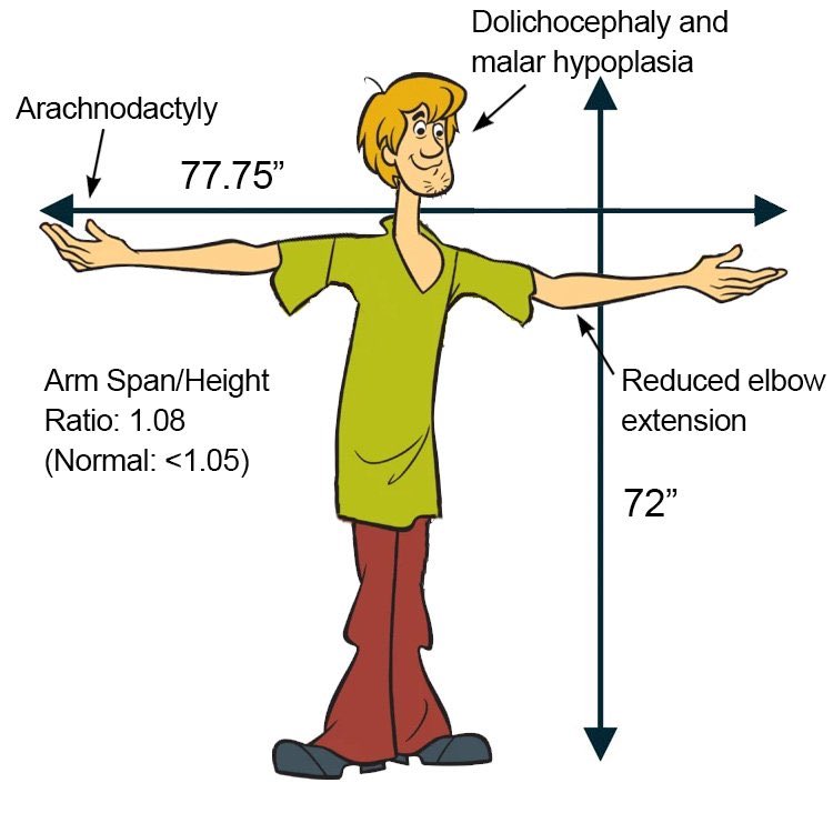 Shaggy was in risk of acute aortic dissection: Marfan syndrome ⤵️! By Dr <a href="/FredWuMD/">Fred Wu, MD 🫀 吳明杰</a>! #Some4Surgery #MedTwitter <a href="/drdevirgilio/">Christian de Virgilio MD FACS</a> <a href="/jmills1955/">Joseph L. Mills MD</a> <a href="/gabrielcirugia/">Gabriel Herrera MD FACS</a> <a href="/almagoch/">Alberto</a> <a href="/PipeCabreraV/">Dr Luis Felipe Cabrera Vargas MD FACS</a> <a href="/juliomayol/">Julio Mayol</a> <a href="/SWexner/">Steven D Wexner MD, PhD</a> <a href="/farkomd/">frank arko</a>