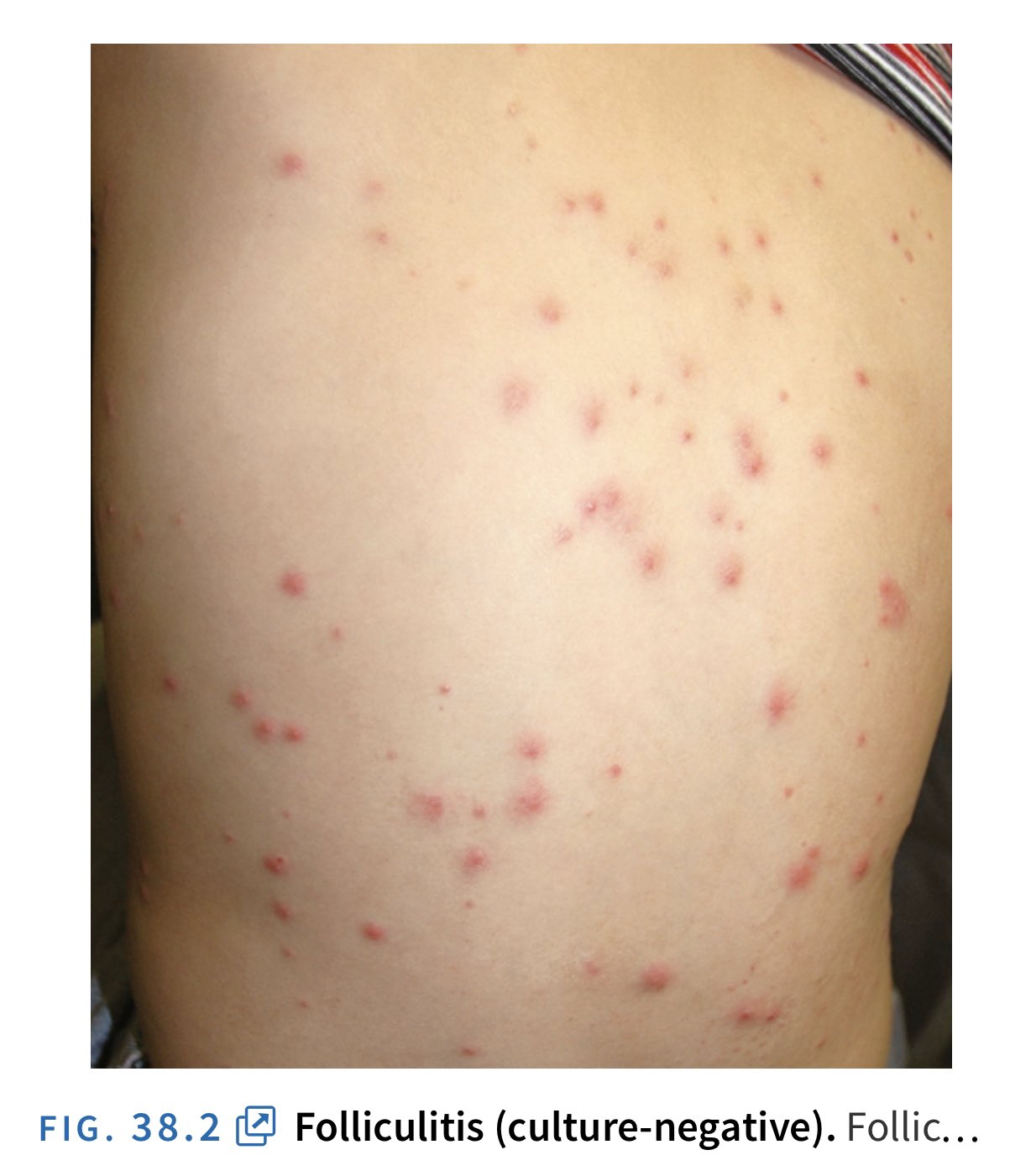 Tangs Clinical TCM on Twitter "These red spots are NOT ECZEMA. They