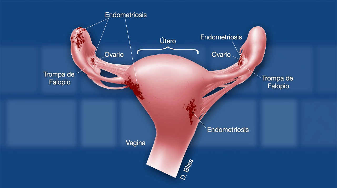 Endometriosis en vejiga