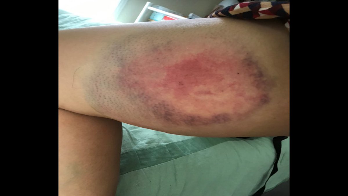 henrykleeKTVU's tweet photo. Independent journo @SarahBelleLin sues @CA_Richmond via @BuelnaFTP @AdanteEsq, saying she was wearing press badge &amp; camera on neck when @RPDCAOnline officer providing mutual aid shot her in thigh w/rubber bullet as she covered May protest in Oakland over killing of George Floyd https://t.co/lMoJmuYHRS