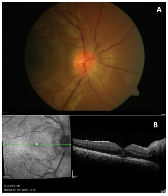 NDTsocial's tweet photo. 🆕Tubulointerstitial nephritis and uveitis syndrome: a systematic review
➡️Adult age and the presence of a posterior #uveitis or #panuveitis appear to be associated with the development of #CKD
📖https://t.co/jyAYfycTLj https://t.co/8IY7u39P9k