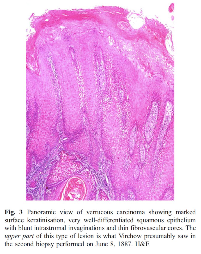 Controversy of missed diagnosis had raged since then, and multiple recent reconstructions, have proposed that is might have been verrucous carcinoma, a rare and difficult diagnosis. Even after 100 years, diagnosis was missed in ~50% of patients.  https://tinyurl.com/2rwhptkw&nbsp;