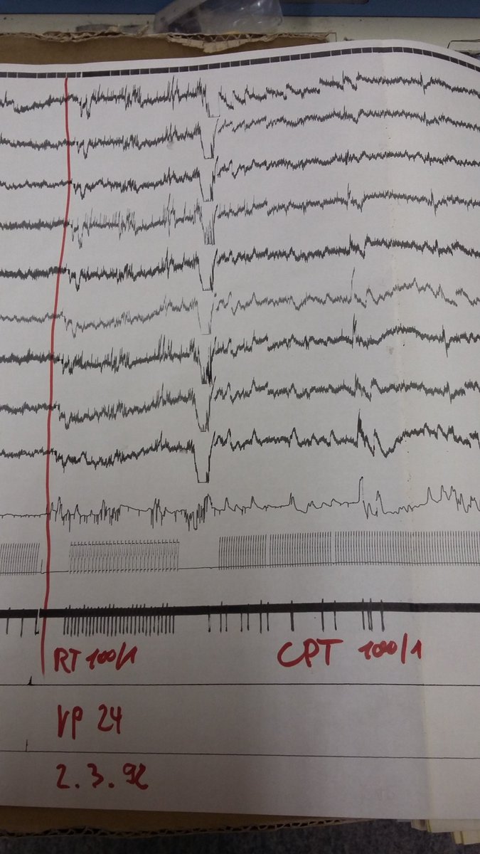 NeuroBarbara's tweet photo. #ThrowbackThursday That is how we measured EEG 30 years ago using paper and microvolt templates! See a subject recording from 1992! Found this old machine in our lab. Exciting to see how our technical possibilities developed since then! @AcademicEEG @TheRealSPR https://t.co/i66PNByRbp