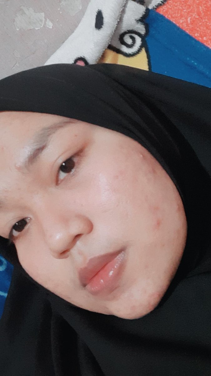 Dan ini kondisi kulitku yg sekarang, semoga bermanfaat yah Before afternya guys  #scarlettserum  #skincare  #scarlettacne  #scarlettwhitening