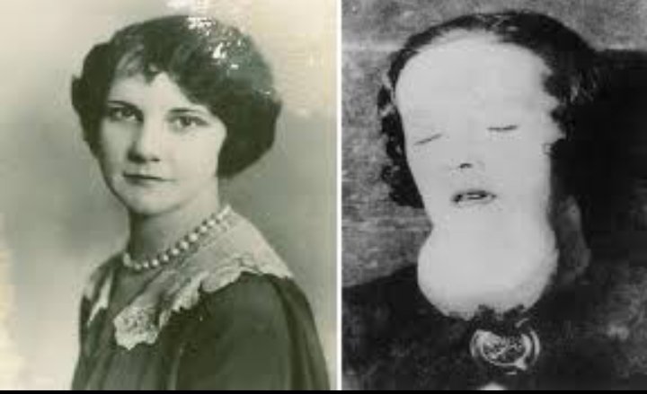 The women workers developed mouth sores, their jaws crumbled, their legs snapped, they collapsed and eventually died. The company paid hush money to the Radium victims, then claimed they had died of syphilis. Radium wasn't to blame.