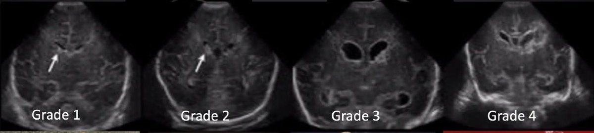 jv coumans (@jvcoumans) on Twitter photo Cameron Sadegh <a href="/csadegh/">Cameron Sadegh</a> brings a new perspective to #hydrocephalus in an outstanding grand rounds this morning & illustrates the power of collaboration <a href="/MGHNeurosurg/">MGH Neurosurgery</a> <a href="/MGHNeuroSci/">MassGeneralNeuroscience</a> Cameron Sadegh <a href="/csadegh/">Cameron Sadegh</a> brings a new perspective to #hydrocephalus in an outstanding grand rounds this morning & illustrates the power of collaboration <a href="/MGHNeurosurg/">MGH Neurosurgery</a> <a href="/MGHNeuroSci/">MassGeneralNeuroscience</a>