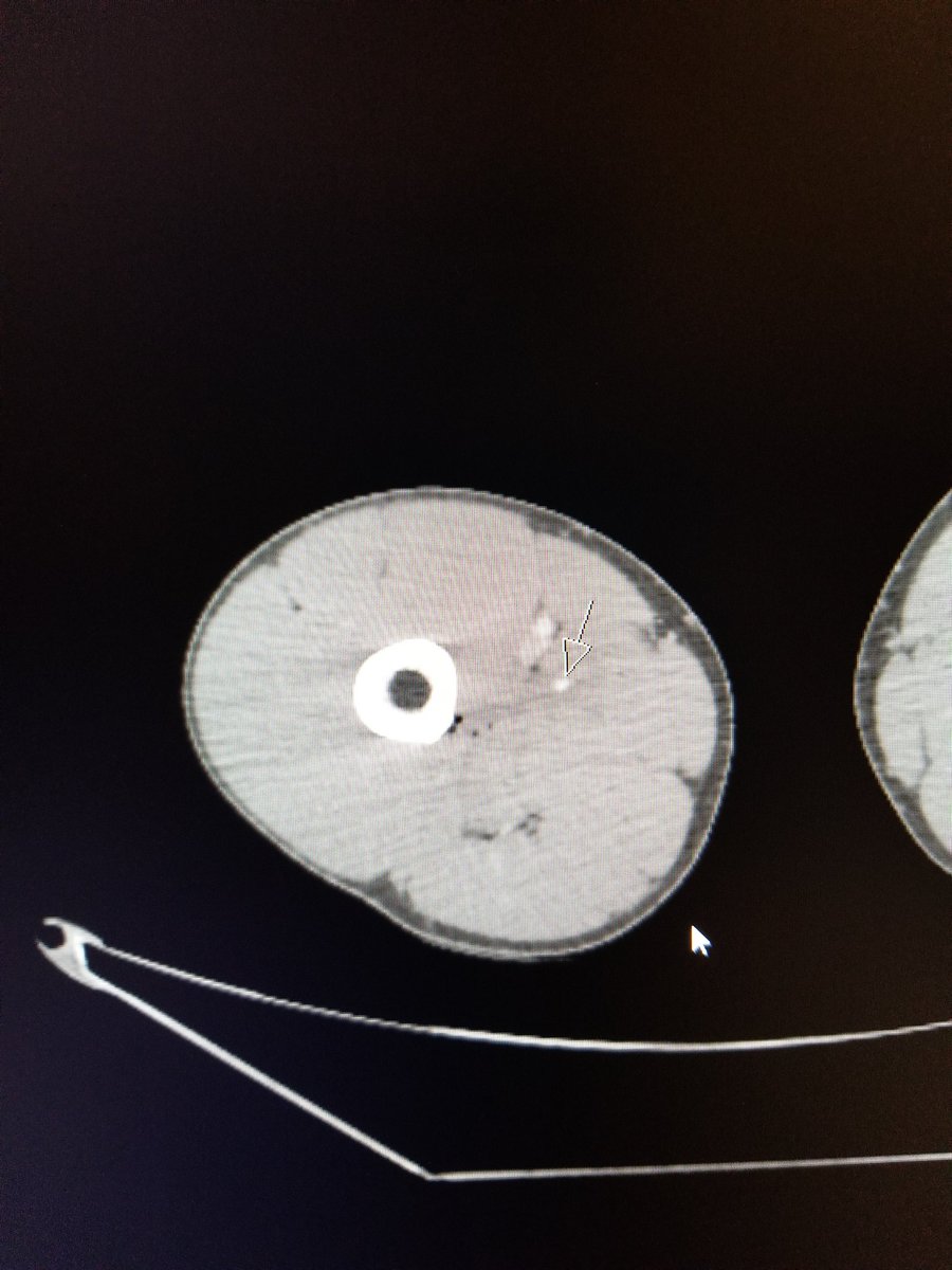 TempleRADs's tweet photo. Patient "accidentally sat" on a knife in his couch. Subtle blush on CTA. Active bleeding on angiogram from multiple SFA branches. Coil embolized both branches. Great overnight call by @CVeselis. Sweet embolization performed by @chanrahan21. @TempleRadRes @SIR_ECS @SIRRFS #IRAD https://t.co/zPGRPJmGyH