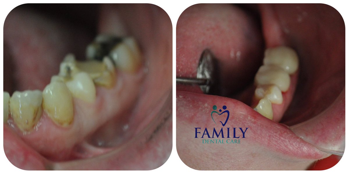 FDCofErie's tweet photo. Lower left morning repair on a new patient went smoothly. https://t.co/3AE7k5cXE4