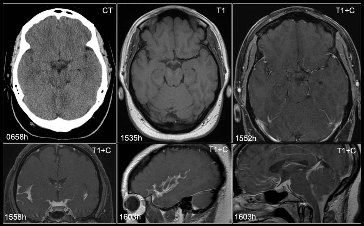 ~30F p/w acute onset HA, R facial numbness. Initial CT neg. A few hours later➡️trigeminal protocol MR. Reports worsening headache on scanner. What's going on? #radres #FOAMrad #RadEd