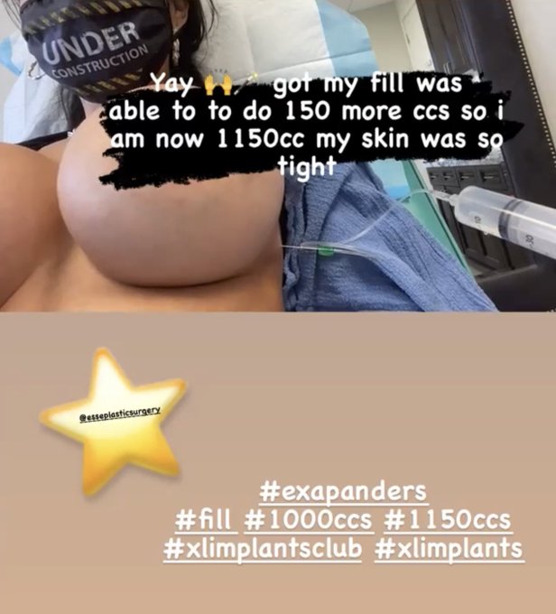 #expanders #xlimplants #boobexpansion #xltits #plasticsurgery #pladticfantastic #bimbogoddess #bimbotraining