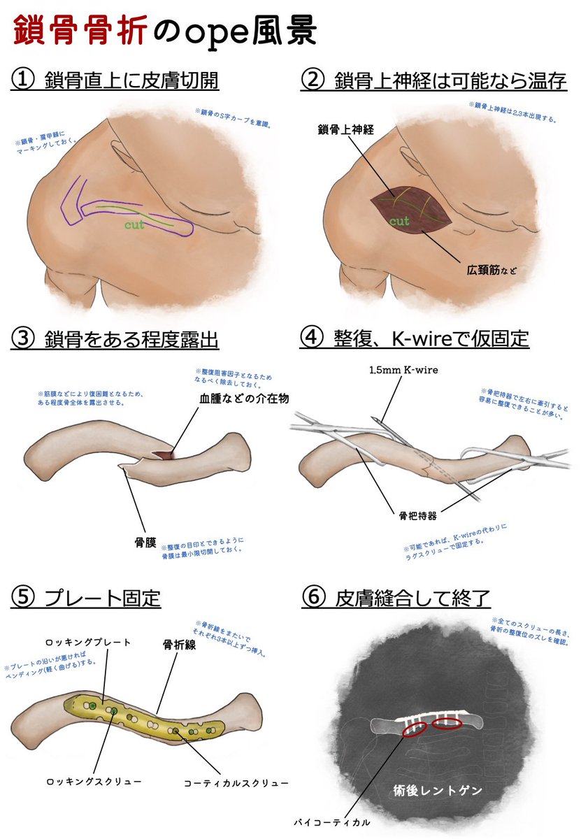 ユジカワ 整形dr イラストレーター 鎖骨骨折のope風景 鎖骨上神経の温存は意見が分かれるところ 温存したとしても 抜釘の時に損傷することが多い 損傷したとしても 周囲のピリピリ感が出たり 全く症状が出ない人もいる 僕は 積極的には同定