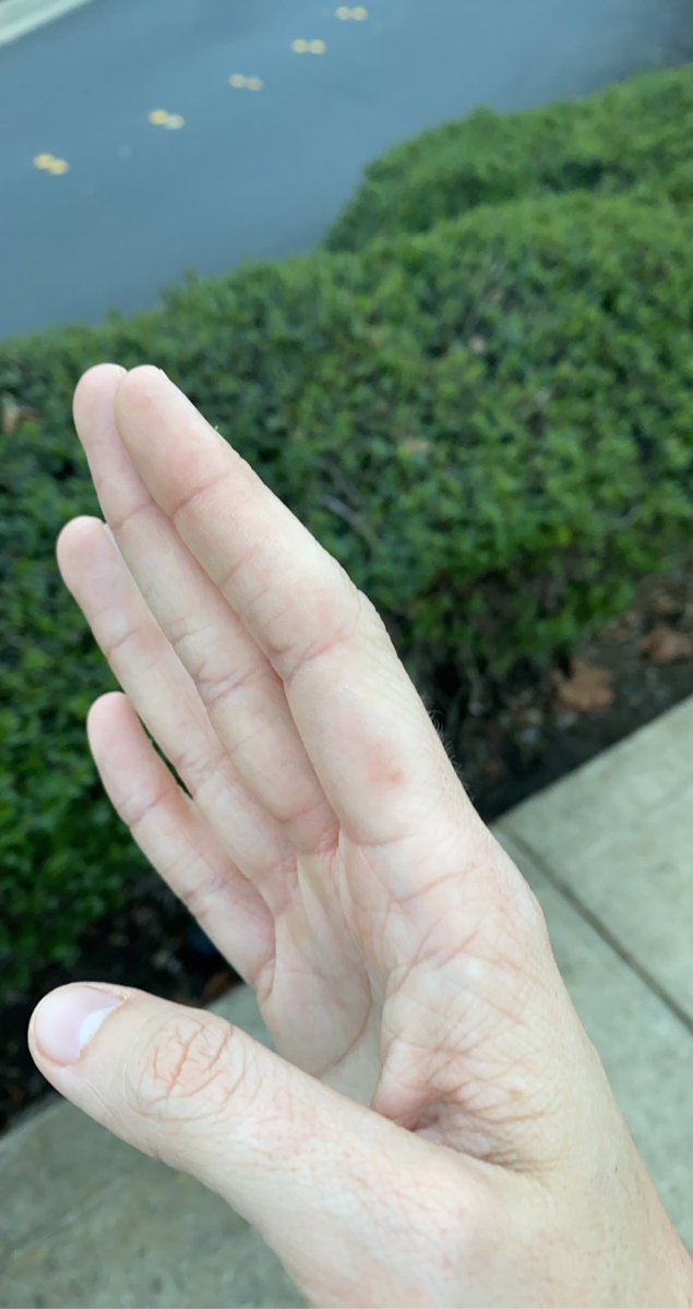 AirsoftGurl's tweet photo. When you jam too hard you bruise and blister your fingers🤣 Five straight hour stream yesterday! WORTH EVERY MINUTE😝🤟🥁 

#drums #drummer #rockband #rockband4 #stream #live #smalstreamer #justforfun https://t.co/MTFWbG1uVM