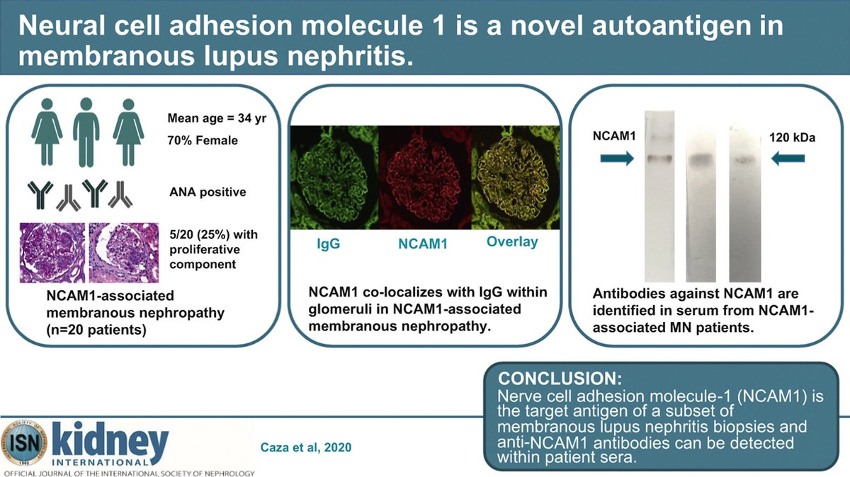 #NCAM1: a novel autoantigen in #membranous #lupusnephritis
doi.org/10.1016/j.kint…
@Tiff_Caza @renalpathdoc