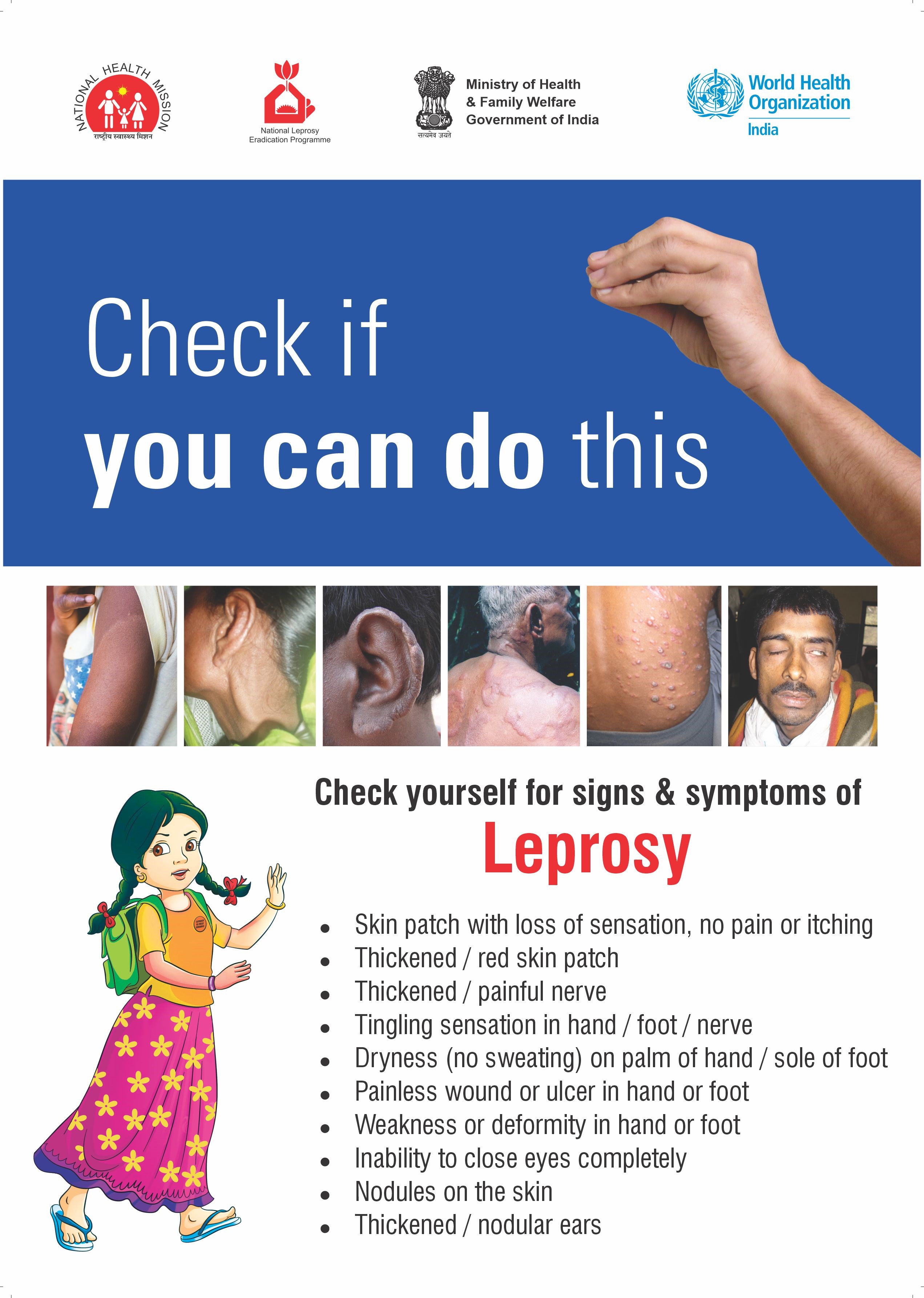 WHO South-East Asia on Twitter: "On #WorldLeprosyDay, learn about the signs  &amp; symptoms of #leprosy. Remember, if detected early, we can prevent  leprosy-related #disability. #EndTheNeglect #beatNTDs #beatleprosy  https://t.co/M3oUxRFQ1X" / Twitter