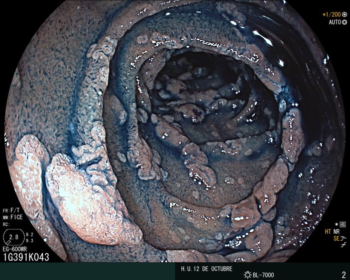 Duodenal adenomas (picture) are a common problem in the upper GI of the patients with familial adenomatous polyposis (FAP)However, adenomas and gastric cancer are a matter of increasing concernA thread with a poll at the end @SEEDendoscopia  @aegastro