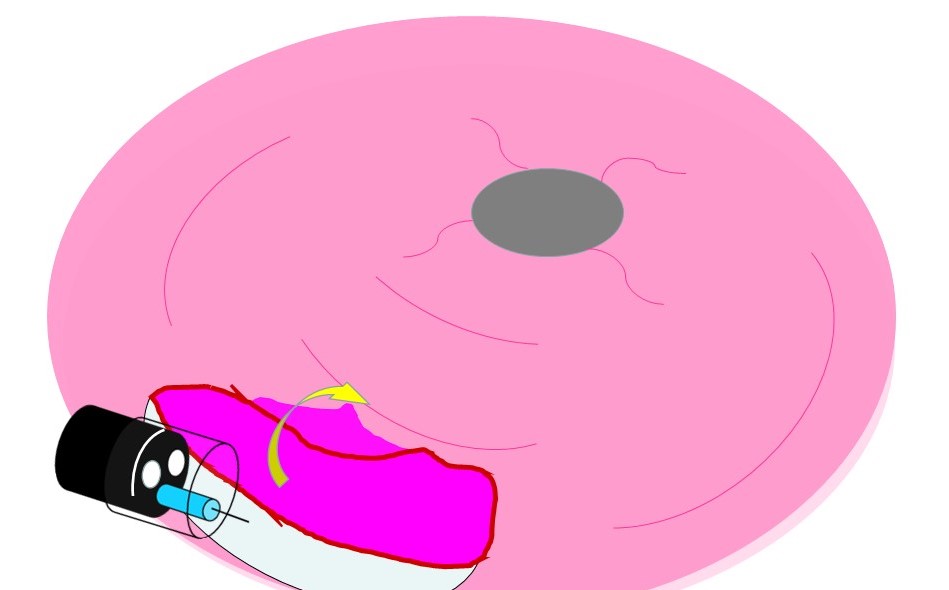 Gastric adenomas > 20mm had a 33% risk of harboring HGD compared with 4 % in adenomas ≤ 20mmESD was performed in 2 cases of lesions > 20 mm and LGD was observed in both.