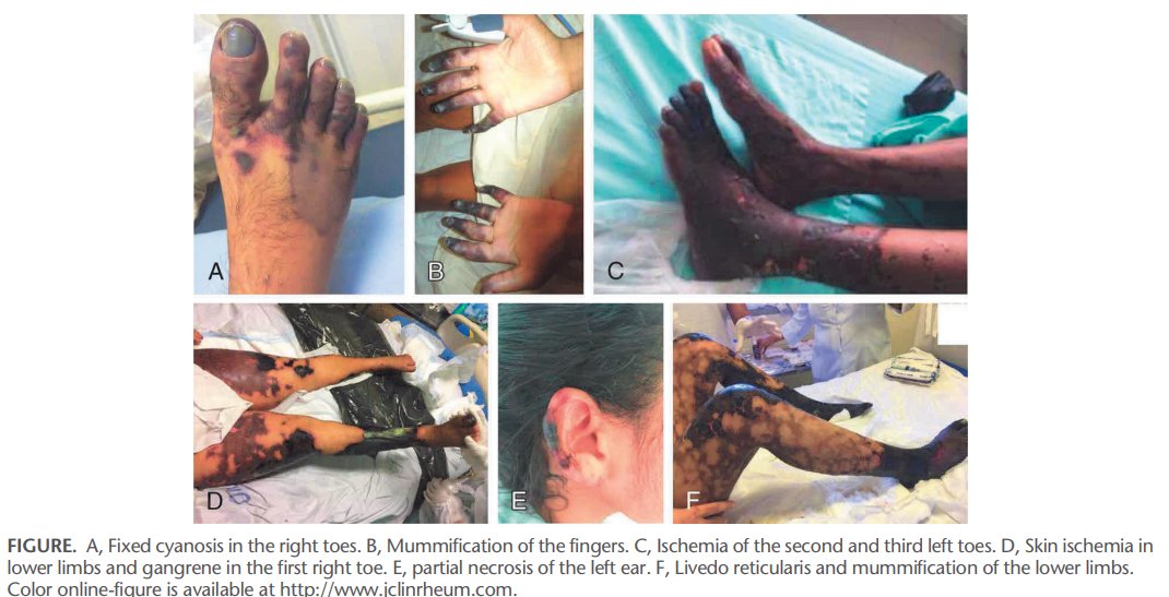 An interesting case-based reviewAcute peripheral/cutaneous ischemic syndrome (APCIS), what rheumatologist should know?APCIS is a clinical syndrome, representing the clinical appereance of skin and/or limb severe ischemia due to several etiologies. https://pubmed.ncbi.nlm.nih.gov/33315786/&nbsp;