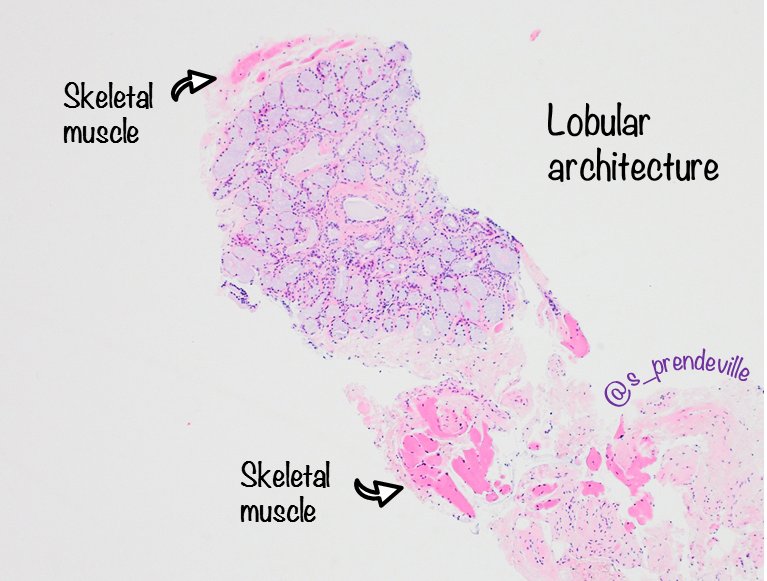 s_prendeville's tweet photo. Cowper gland on prostate biopsy #beautyinbenign

🔹Typically seen in apical biopsies
🔬 Lobular architecture 
🔬 Mixture of acini and ducts
🔬Adjacent skeletal muscle
🔬Basal cells present

🔸May mimic foamy gland adenoca
➡️ Do basal cell markers if needed

#pathresidents #gupath https://t.co/0gBe8fvYRa