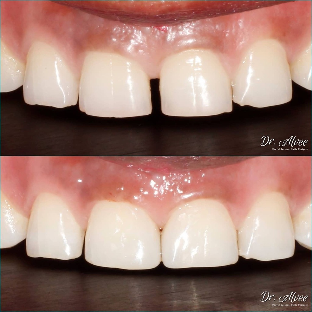 _Alvee's tweet image. Midline diastema correction with #BioClear

#dralvee #dental #Composite #direct_resin #smiledesign #smilemakeover #BioClearMethod #toothfairy instagr.am/p/CKuQh7PHN4-/